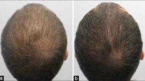 alopecia-tratamientos_esteticos-dermatologia_344727822_101023240_1024x576-300x169
