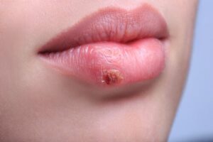 herpes-labial-300x200 OZONO D'OR PINCEL BORRADOR HERPES LABIAL CON OZONO 100 % NATURAL Y BIO 4 ML